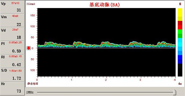 經(jīng)顱多普勒檢測(cè)椎基底動(dòng)脈供血障礙的表現(xiàn) 經(jīng)顱多普勒檢測(cè)椎基底動(dòng)脈供血障礙的表現(xiàn)